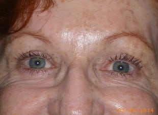 Patient 56 - After View 