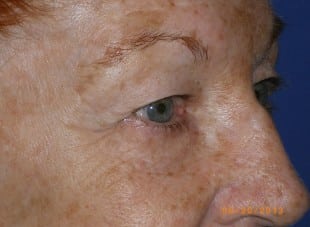 Patient 56 - Before View 