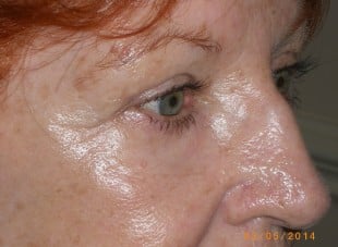 Patient 56 - After View 