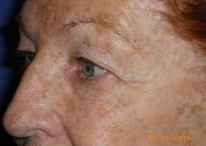 Upper Eyelid Blepharoplasty with Lower Eyelid Laser Resurfacing