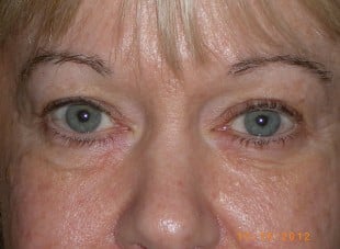 Patient 60 - Before View 