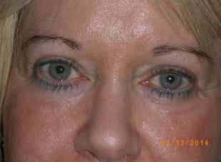 Patient 60 - After View 