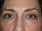 Upper Eyelid Blepharoplasty with Lower Eyelid Laser Resurfacing