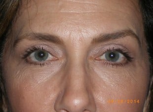 Patient 68 - After View 