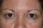 Upper Eyelid Blepharoplasty with Lower Eyelid Laser Resurfacing