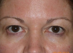 Patient 74 - Before View 