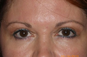 Upper Eyelid Blepharoplasty with Lower Eyelid Laser Resurfacing