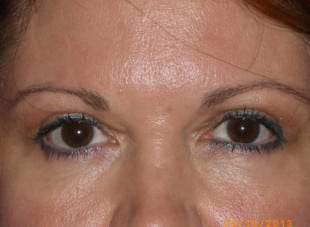 Patient 74 - After View 