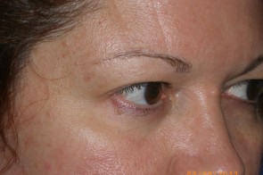 Upper Eyelid Blepharoplasty with Lower Eyelid Laser Resurfacing