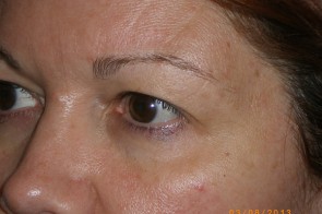 Upper Eyelid Blepharoplasty with Lower Eyelid Laser Resurfacing