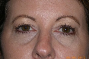 Upper Eyelid Blepharoplasty with Lower Eyelid Laser Resurfacing