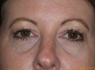 Patient 77 - Before View 