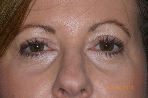 Upper Eyelid Blepharoplasty with Lower Eyelid Laser Resurfacing