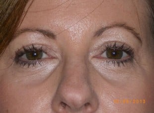 Patient 77 - After View 