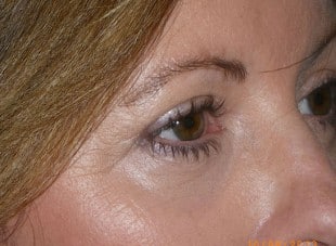 Patient 77 - After View 