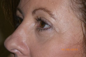 Upper Eyelid Blepharoplasty with Lower Eyelid Laser Resurfacing