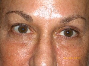 Upper Eyelid Blepharoplasty with Lower Eyelid Laser Resurfacing