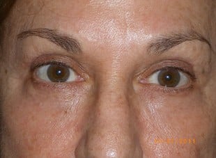 Patient 81 - After View 