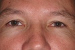 Upper Eyelid Blepharoplasty with Lower Eyelid Laser Resurfacing