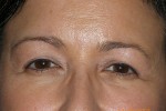 Upper Eyelid Blepharoplasty with Lower Eyelid Laser Resurfacing