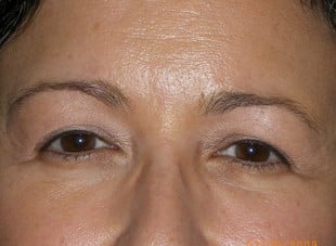Patient 91 - Before View 