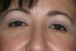 Upper Eyelid Blepharoplasty with Lower Eyelid Laser Resurfacing