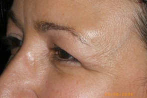 Upper Eyelid Blepharoplasty with Lower Eyelid Laser Resurfacing