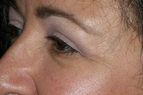 Upper Eyelid Blepharoplasty with Lower Eyelid Laser Resurfacing