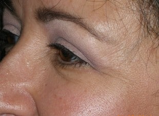 Patient 91 - After View 