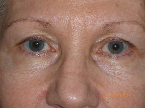 Upper Eyelid Blepharoplasty with Lower Eyelid Laser Resurfacing