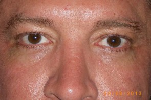 Upper Eyelid Blepharoplasty with Lower Eyelid Laser Resurfacing