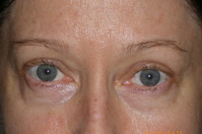 Upper Eyelid Blepharoplasty with Lower Eyelid Laser Resurfacing