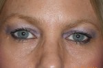 Upper and Lower Eyelid Blepharoplasty with Laser Resurfacing