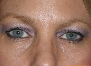 Patient 36 - Before View 