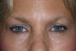 Upper and Lower Eyelid Blepharoplasty with Laser Resurfacing