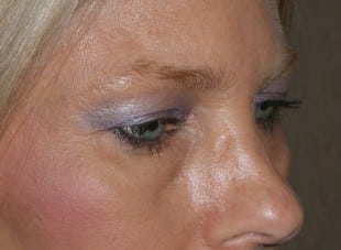 Patient 36 - Before View 