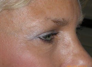 Patient 36 - After View 