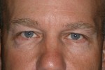 Upper and Lower Eyelid Blepharoplasty with Laser Resurfacing