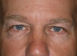 Patient 42 - Before View 