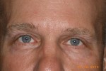 Upper and Lower Eyelid Blepharoplasty with Laser Resurfacing