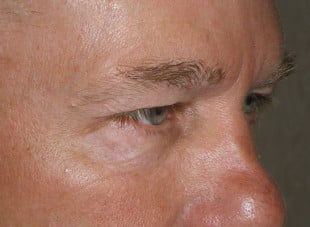 Patient 42 - Before View 