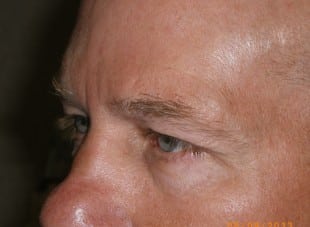 Patient 42 - Before View 