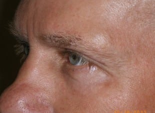 Patient 42 - After View 