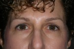 Upper and Lower Eyelid Blepharoplasty with Laser Resurfacing