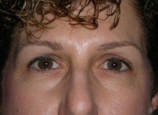 Patient 61 - Before View 