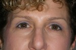 Upper and Lower Eyelid Blepharoplasty with Laser Resurfacing