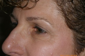 Upper and Lower Eyelid Blepharoplasty with Laser Resurfacing