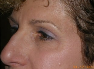Patient 61 - After View 