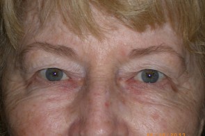 Upper and Lower Eyelid Blepharoplasty with Laser Resurfacing