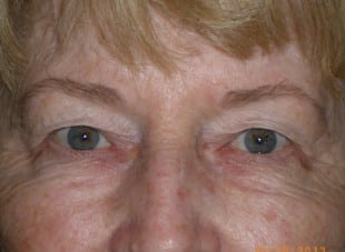 Patient 70 - Before View 
